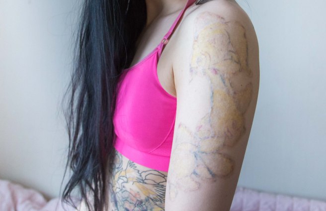 tattoo_removal
